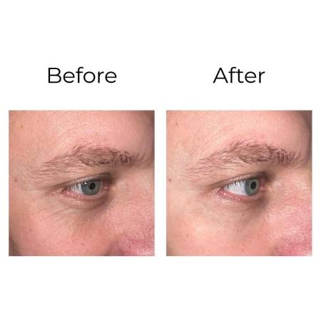 Résultat avant après - Rides contour yeux homme