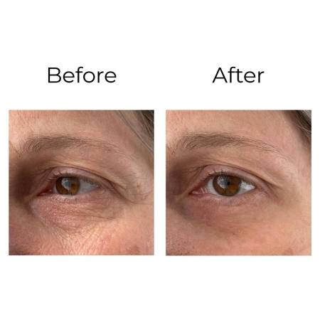 Résultat avant après - Cernes et poches sous les yeux